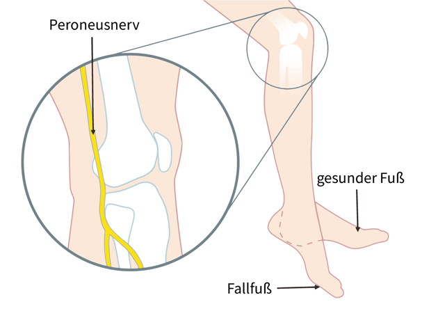 Fußheberschwäche Fallfuß erklärt in Schema mit Peroneusnerv